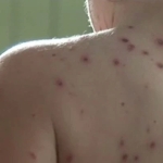 chicken pox