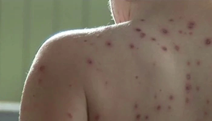 chicken pox