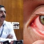 red eye disease